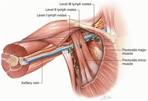 Neck Axillary Ilioinguinal And Other Lymph Node Dissections Oncohema Key