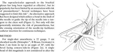 Supraclavicular Fossa With Concept Of Bent Needle Illustrated