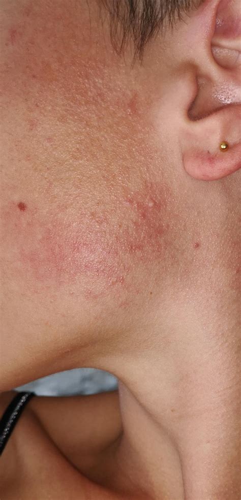 Skin Concerns I Just Found Out In An Other Sub After Being Diagnosed