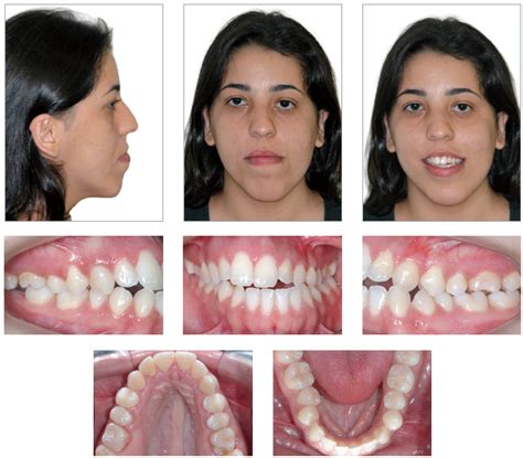 Scielo Brasil Class Iii Malocclusion With Maxillary Deficiency