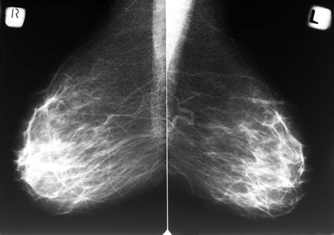 How does breast cancer appear like on a mammogram? answered by dr. Mammogram Risk Update 2017: Is the Word Spreading ...