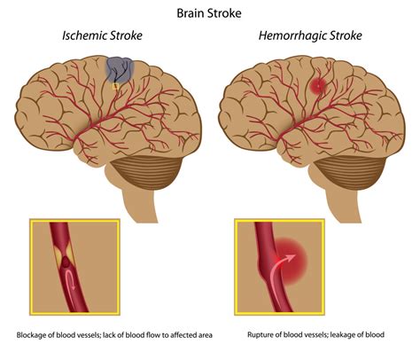 The leaked blood puts too much pressure on brain cells, which damages them. Stroke: The Silent Killer - Interactive Biology, with ...