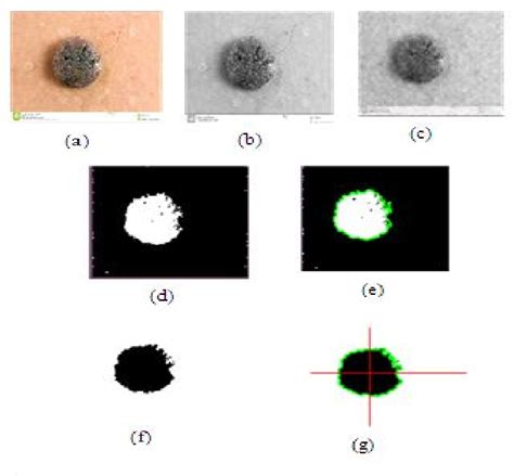 The Melanoma Skin Cancer Detection And Feature Extraction Through Image