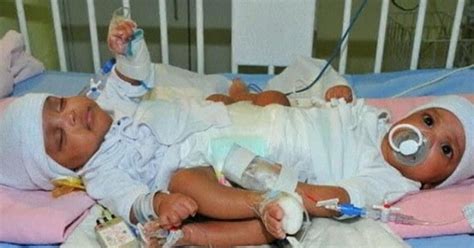 Conjoined twins separated in Saudi Arabia