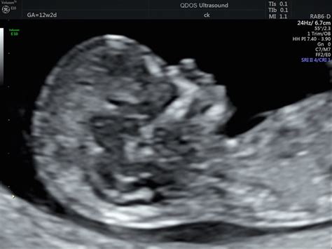 Baby Ultrasound At 12 Weeks
