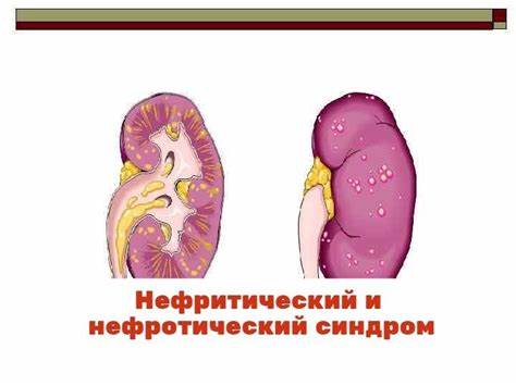 Нефротический синдром диета Нефритический и нефротический синдром отличия и разница Нефритический и нефротический синдром отличия и разница Нефротический синдром диета
