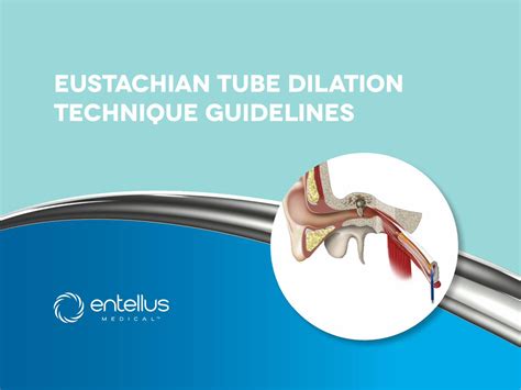 Pdf Eustachian Tube Dilation Technique Guidelines · 2 A Physician
