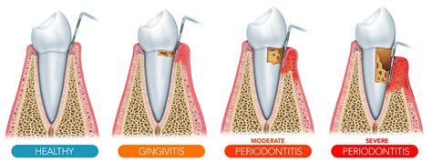 Gum Recession - Longview, TX - Dr. Kovacs