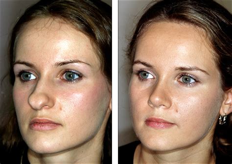 Bulbous Nose Rhinoplasty Before And After