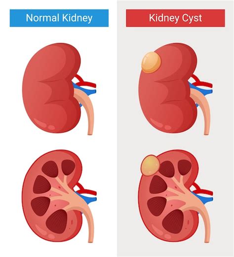 Premium Vector Kidney Disease Normal Kidney And Cyst Kidney Design