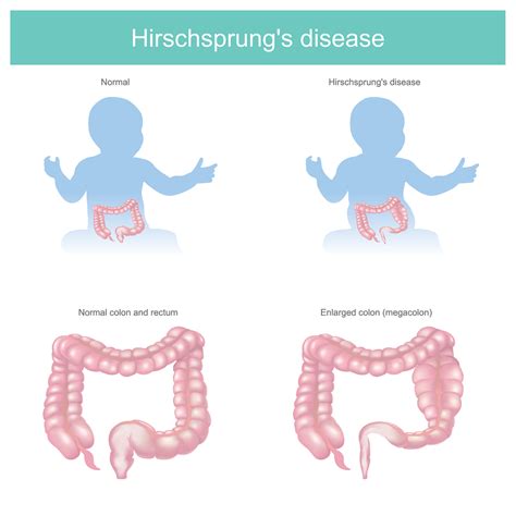what is hirschsprung s disease hirschsprung disease causes symptoms and treatment diseases