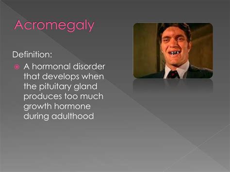Ppt Addisons Cushings And Acromegaly Powerpoint Presentation Id