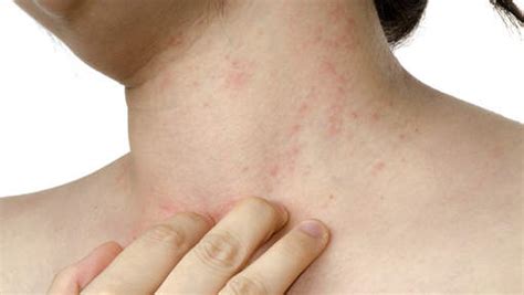 Hives Causes Symptoms And Treatment Health Article