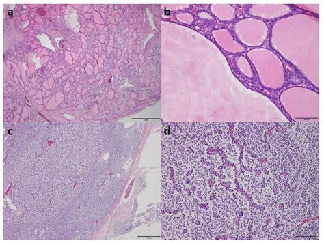 Pathologic Sections Of Nodular Hyperplasia Of The Thyroid Gland Ab