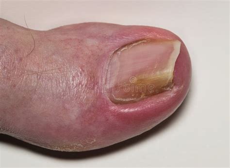 Ingrown Toenail Onychocryptosis On Caucasian Big Toe Hallux Stock