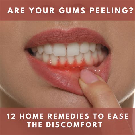 Are Your Gums Peeling How To Fix Them Before Its Too Late Youmemindbody