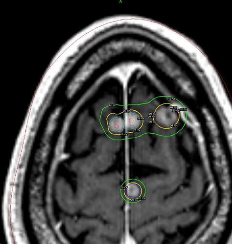 Multiple Brain Metastases As Seen On A T1 Mri Postcontrast From Lung