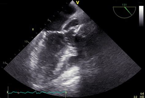 Aortic Root Abscess As Seen On Transesophageal Echocardiography A