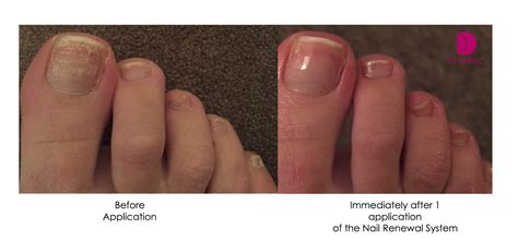 White Discoloration On Toenails After Nail Polish Nail Ftempo