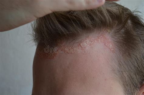 Psoriasis Sur La Peau Photo Stock Image Du Dermatologie 125312106