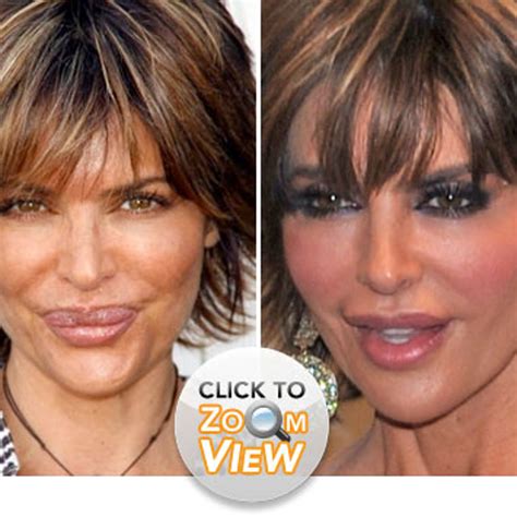 Lisa Rinna Lips Before And After