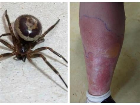 Woman Hospitalised For A Week After False Widow Spider Bite Leinster