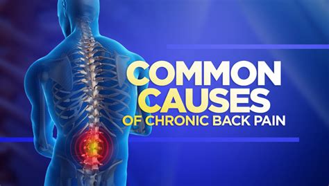 Common Causes Of Chronic Back Pain Kennedy Health Pain Relief And Wellness