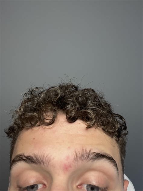 Constant whiteheads/deep red spots between eyebrows : r/AcneTreatments