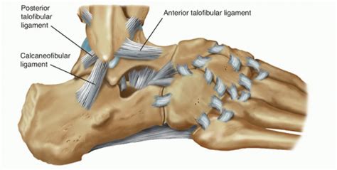 Chronic Lateral Ankle Instability Musculoskeletal Key