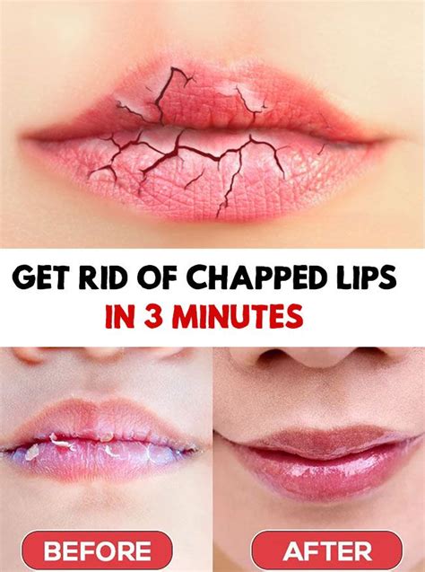 Chapped Lips Get Rid Of Chapped Lips In 3 Minutes Chapped Lips Dry