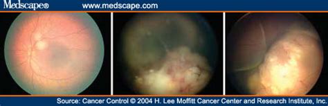 For example, if leukoplakia is caused by a rough tooth or an irregular surface on a denture or a filling, the tooth will be. Figures