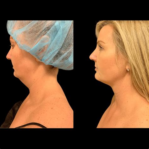 Before And After Neck Liposuction Neinstein Plastic Surgery