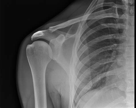Post Traumatic Osteolysis Of Outer End Of Clavicle Image