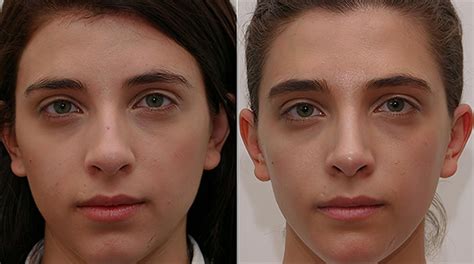 Rhinoplasty For Just The Tip Of The Nose Magnum Workshop