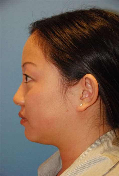 Asian Plastic Surgery Before And After Photos Seattle Bellevue