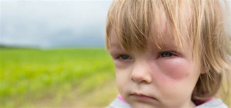 Childhood Allergies Parenting Hub