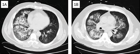 Figure 1 From A Case Of Eosinophilic Granulomatosis With Polyangiitis