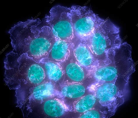 Breast Cancer Cells Light Micrograph Stock Image M1220418