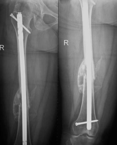 Femur Bone Anatomy X Ray