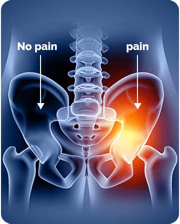 Pelvic Girdle Pain Symptoms Causes And Treatment Anssi