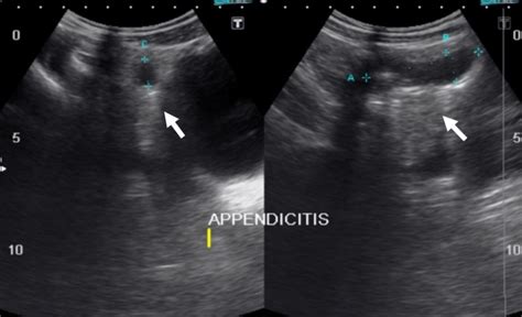 Target Sign In Appendicitis Although Signs And Symptoms Of