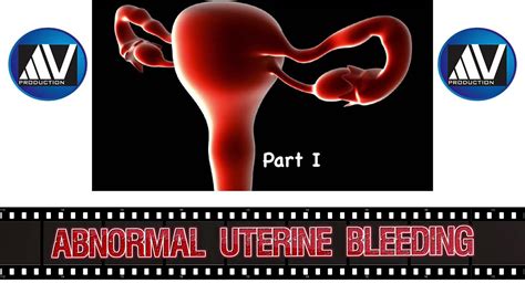 Abnormal Uterine Bleeding Part I Youtube