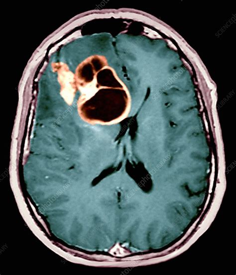 Brain Cancer MRI Scan Stock Image M134 0469 Science Photo Library