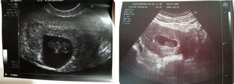 8 Weeks Pregnant Belly 8 Weeks Pregnant Symptoms Baby Development