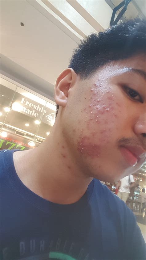 Is This Acne Or Folliculitis Please Help General Acne Discussion