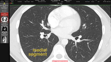 Lobar And Segmental Lung Anatomy On CT YouTube