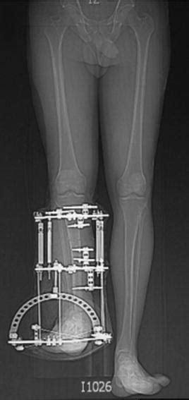 Shortening Of Limb After Fracture Surgery