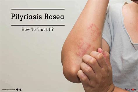 Pityriasis Rosea How To Track It By Dr Nishant Jain Lybrate