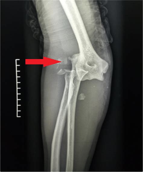 Standard X Ray Of The Elbow Showing A Terrible Triad With Type 2