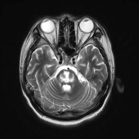 The Trident Sign Of Central Pontine Myelinosis Https Radiopaedia Org